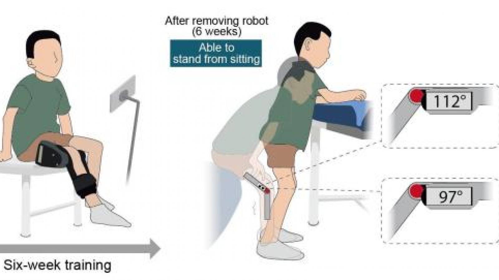 Trung Quốc phát triển robot đeo hỗ trợ trẻ mắc teo cơ tủy sống phục hồi vận động