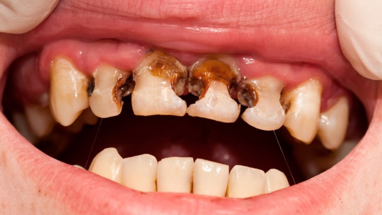 Nhiều người có hàm răng xấu mà không biết nguyên nhân bắt nguồn từ đâu