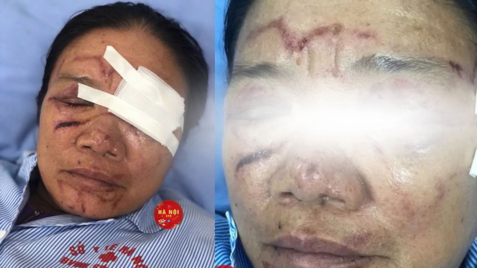 Vụ tiểu thương bị xịt nước chảy máu mắt ở Phú Thọ: Diễn biến sức khỏe ra sao?