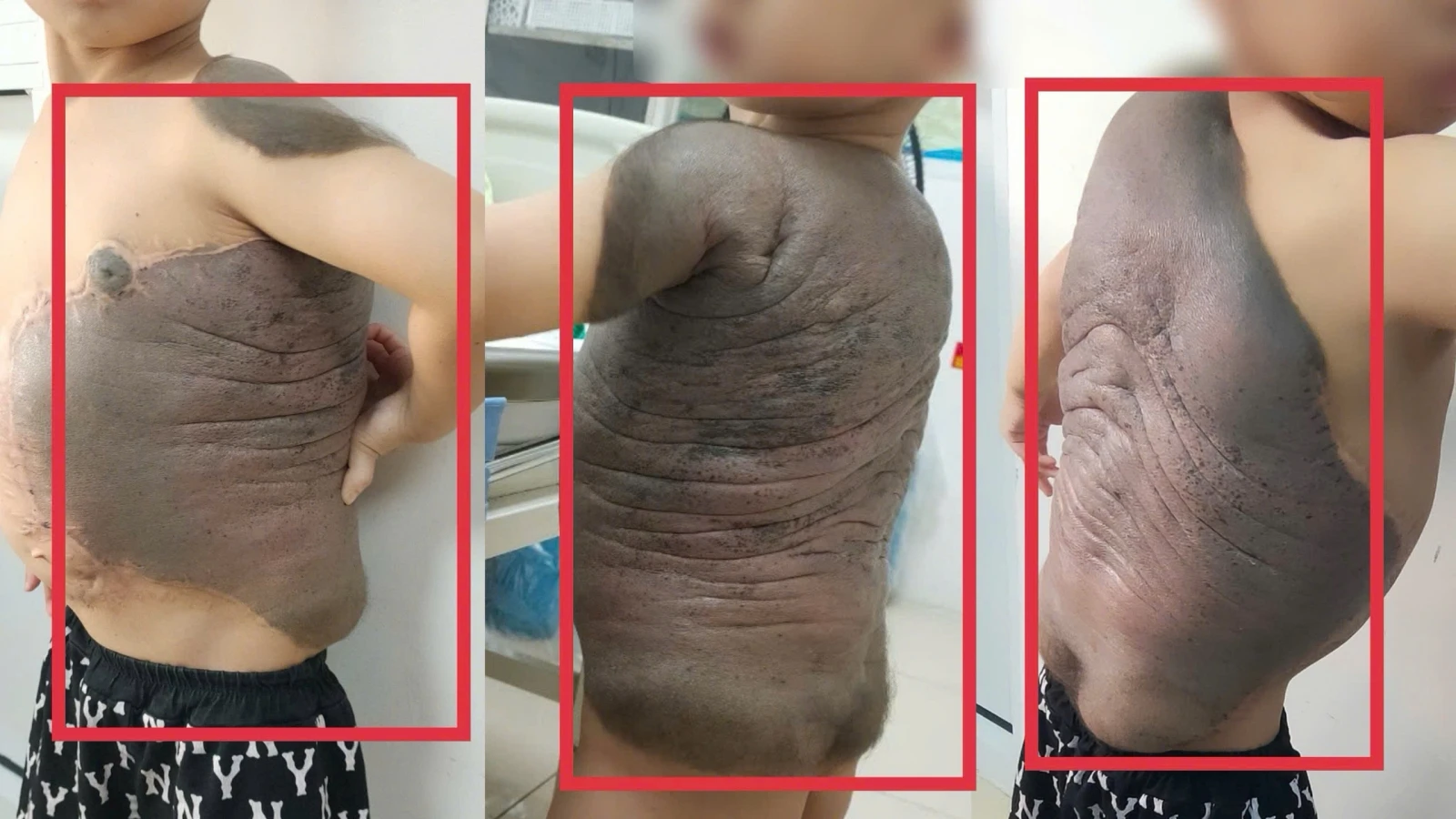 6 lần phẫu thuật giúp cậu bé mang "mai rùa" trên lưng đứng thẳng