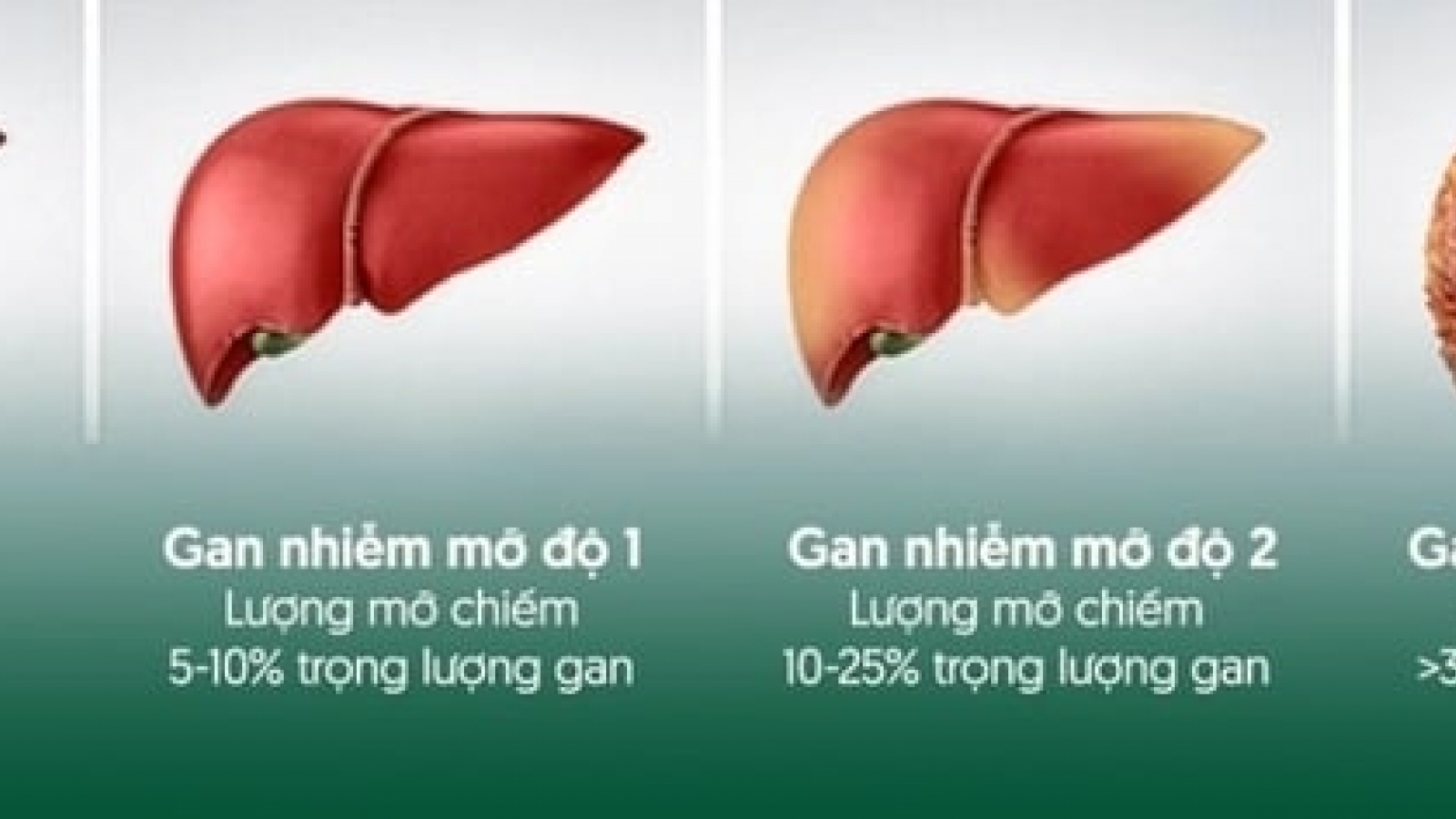 PGS Nguyễn Lân Hiếu khuyên đừng vội uống thuốc bổ gan khi mới phát hiện nhiễm mỡ