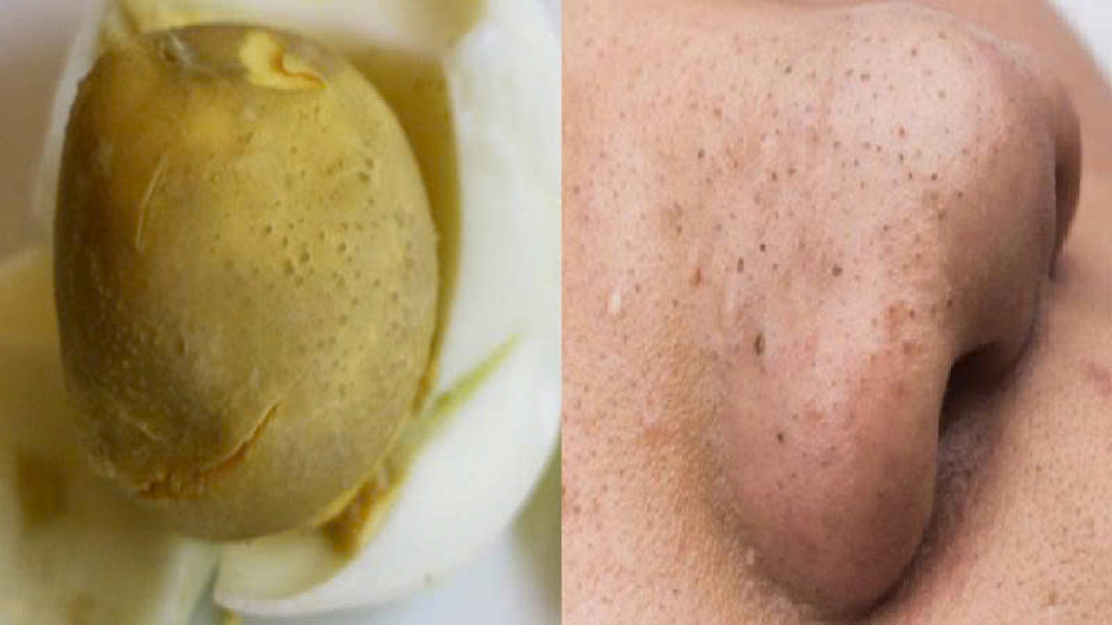 Lăn trứng gà có hút được mụn như lời đồn?