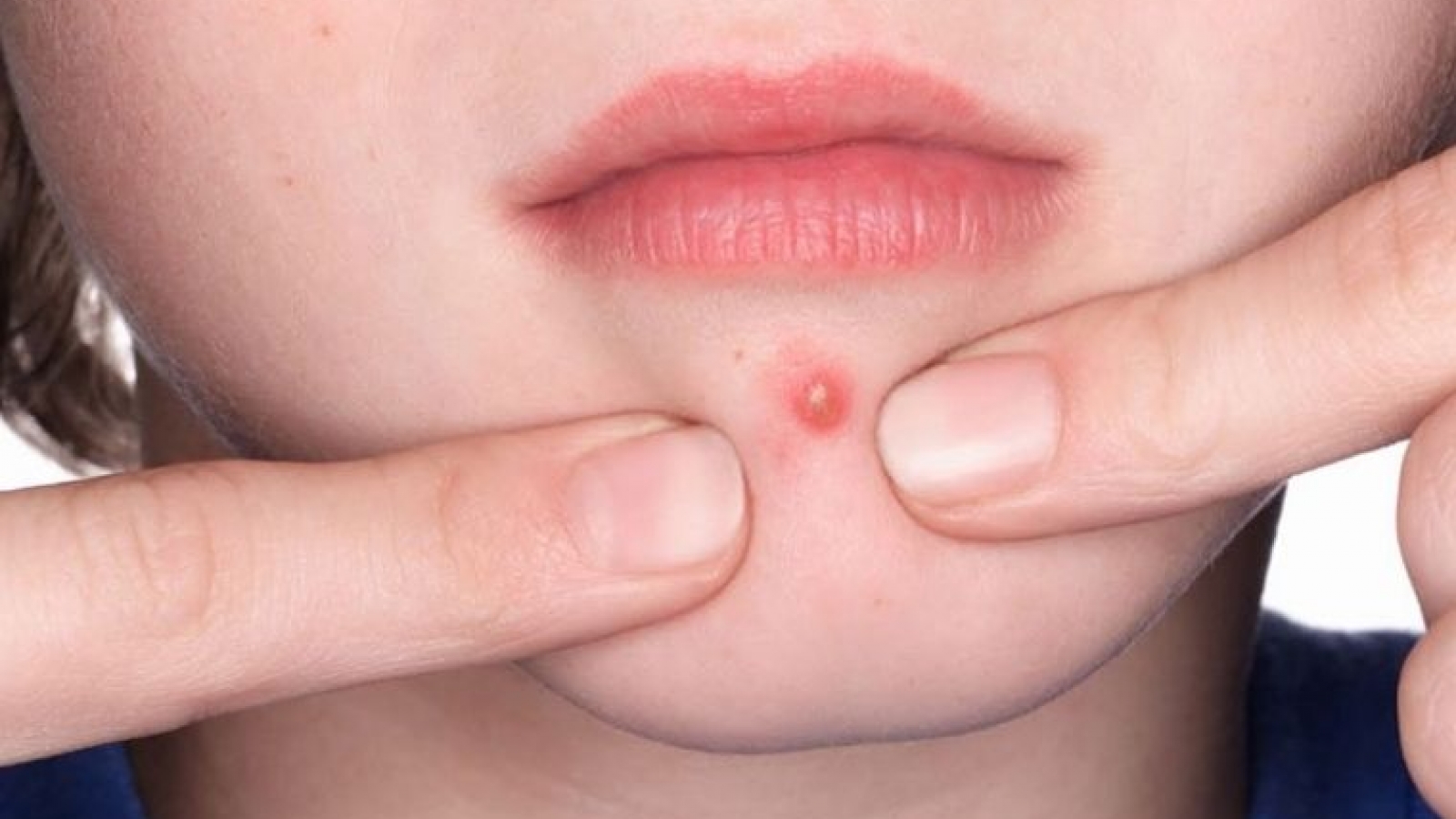 Nặn mụn xong bị sưng tấy, làm sao để da nhanh hồi phục?