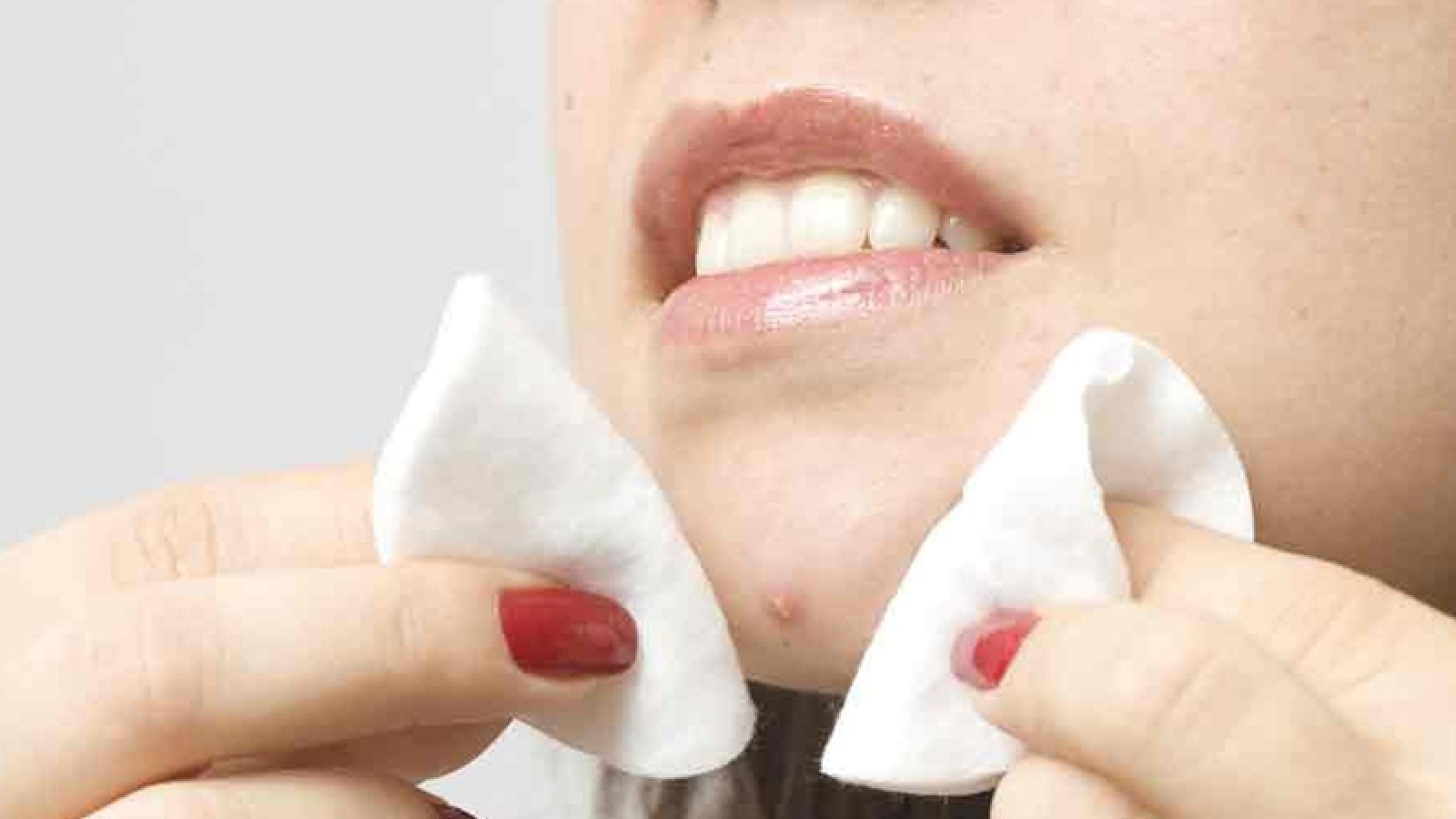 Không nặn mụn nhưng vẫn bị rỗ mặt, vì sao?