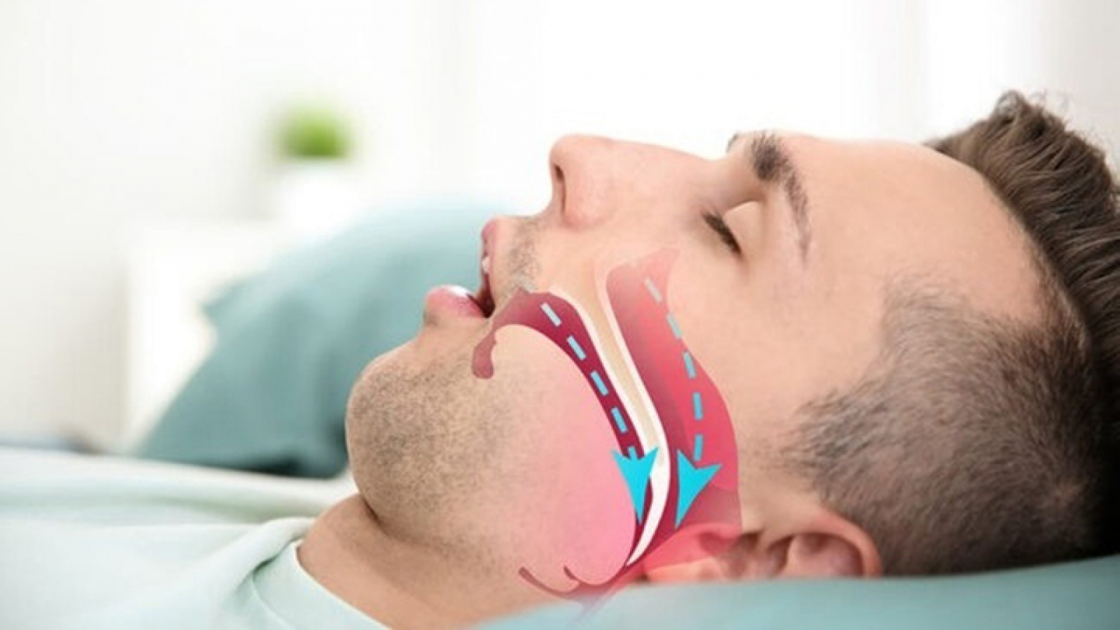 Ngáy to bị vợ giục đi khám, phát hiện căn bệnh có thể dẫn đến đột quỵ