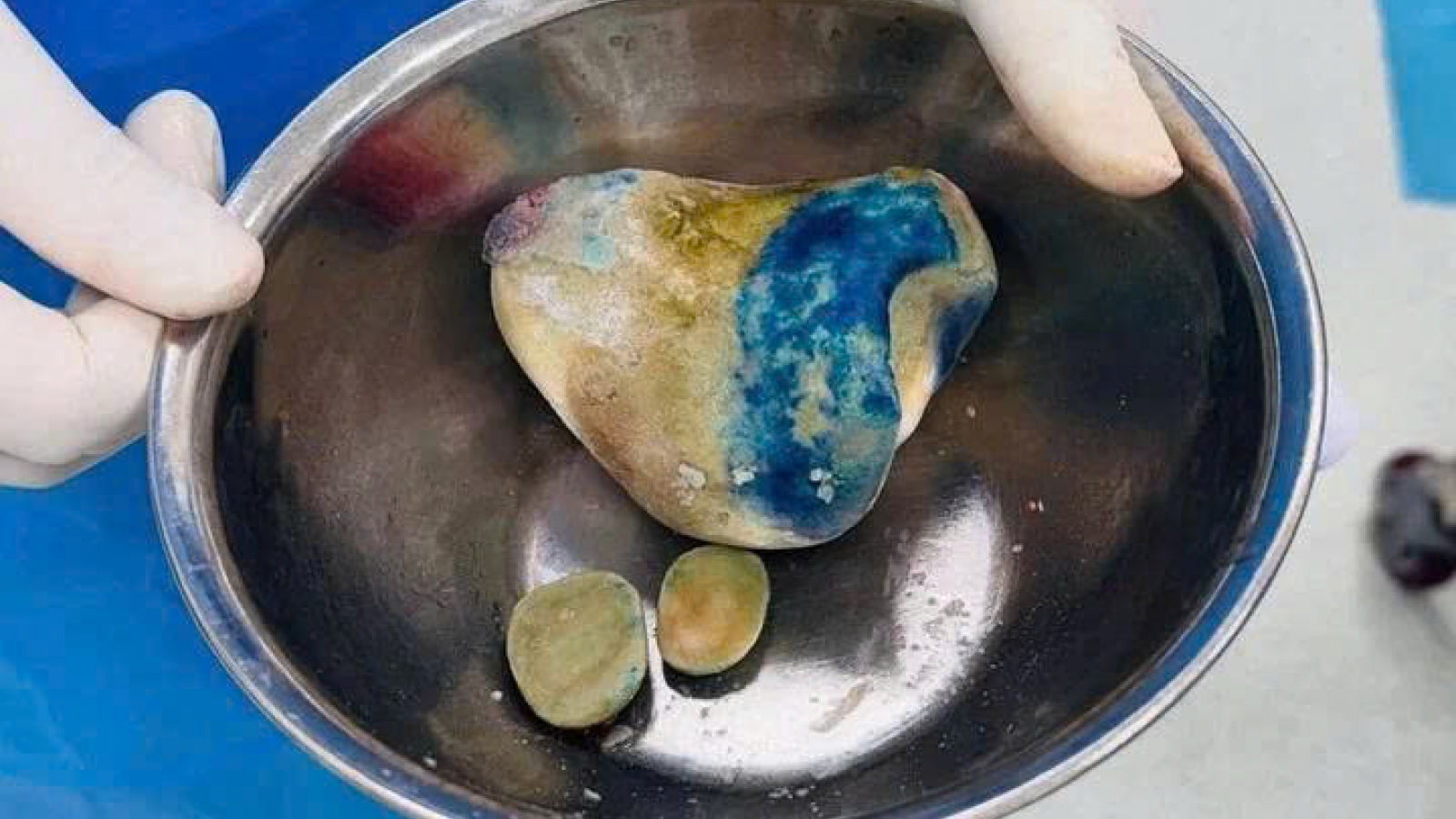 Cụ ông 86 tuổi mang khối sỏi bàng quang gần nửa kg