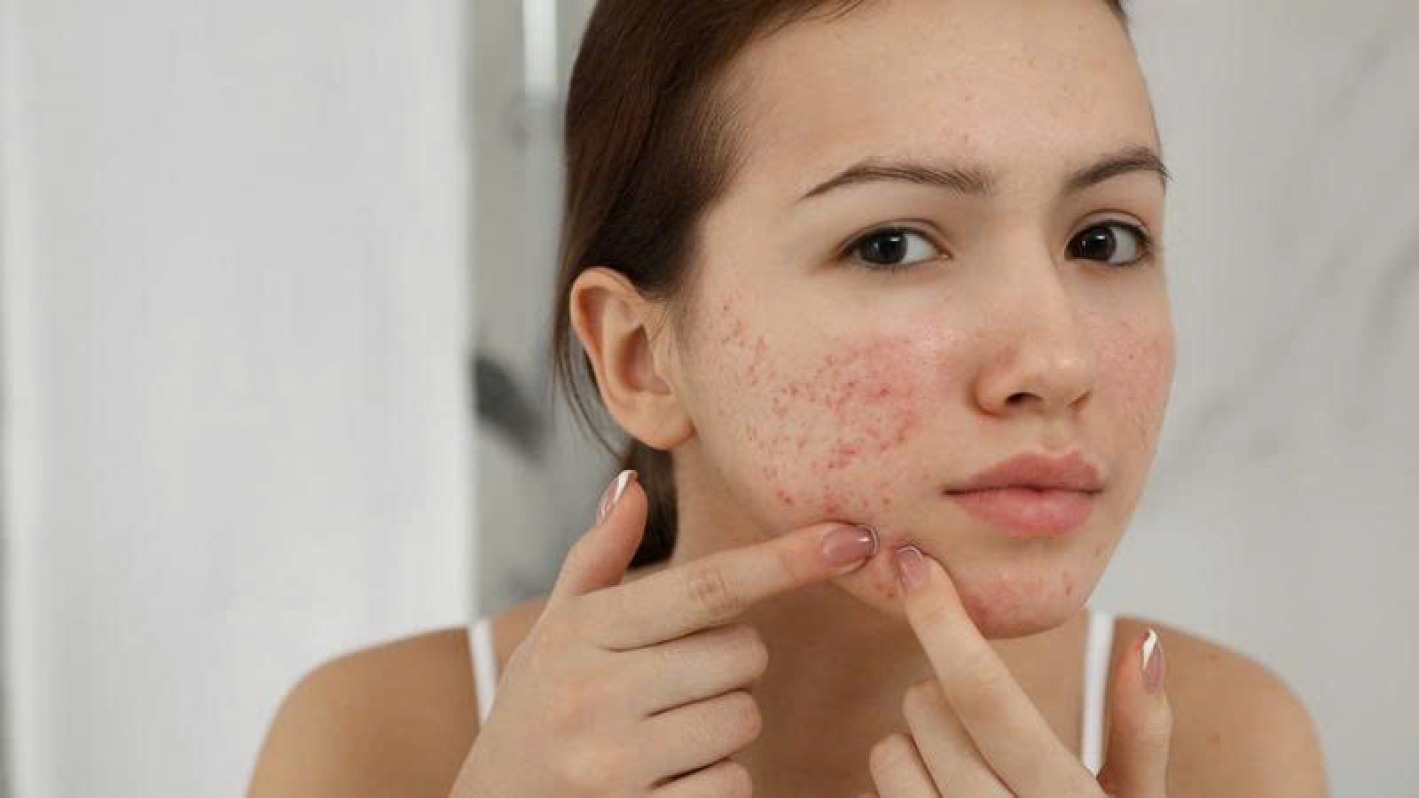 Vì sao cứ đến kỳ kinh mụn lại nổi? 5 cách giúp da ổn định