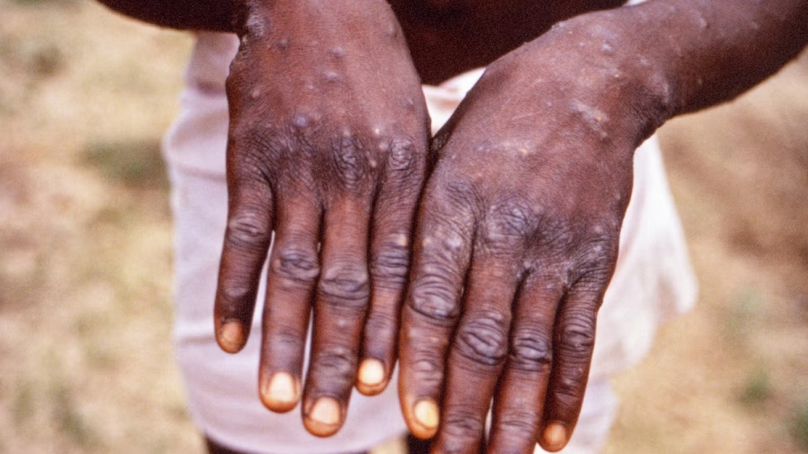 Guinea-Bissau đối mặt với đợt bùng phát bệnh đậu mùa khỉ