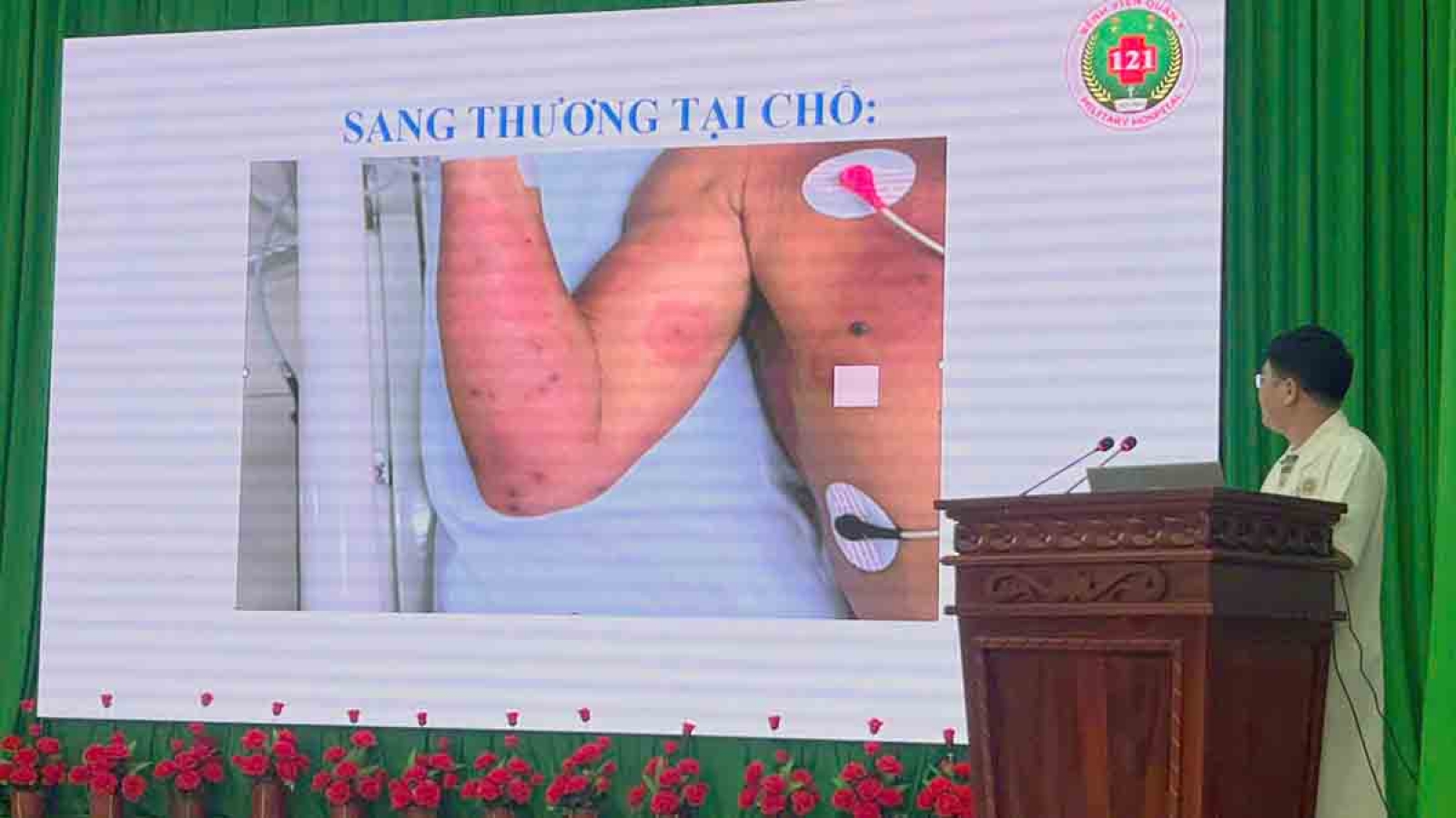 Cứu sống bệnh nhân bị ong vò vẽ đốt 150 vết