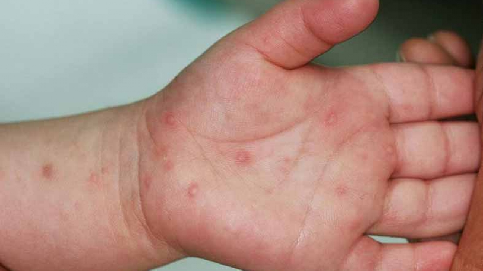 Cả nước ghi nhận hơn 3.000 ca tay chân miệng mỗi tuần, Bộ Y tế cảnh báo