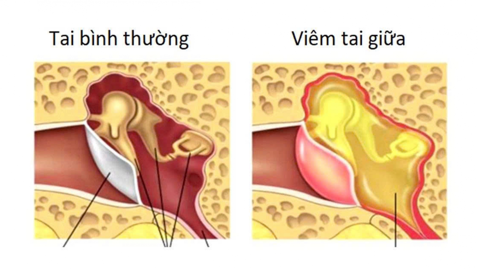 Đau tai, ù tai chớ chủ quan: Nhận biết 3 dạng viêm tai thường gặp