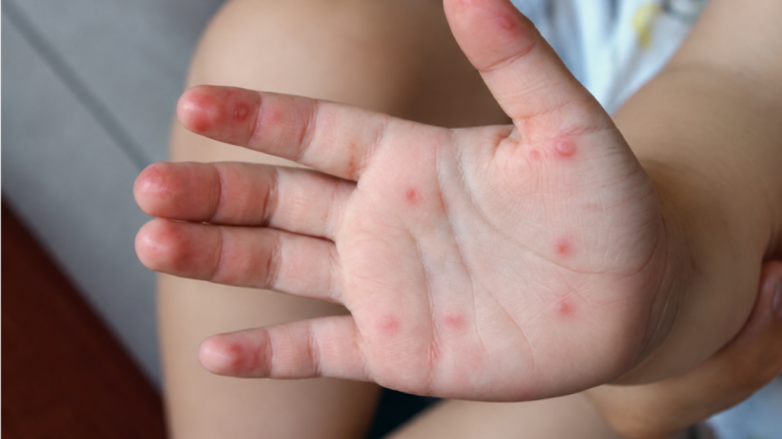 Gần 1.000 ca tay chân miệng – làm sao để bảo vệ trẻ nhỏ trong năm học mới