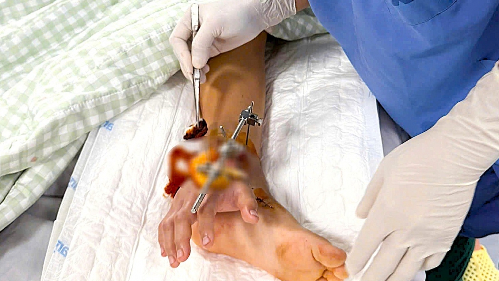 Vụ sập cổng làng ở Hà Tĩnh: Nối tạm bàn tay bé lớp 3 vào cẳng chân