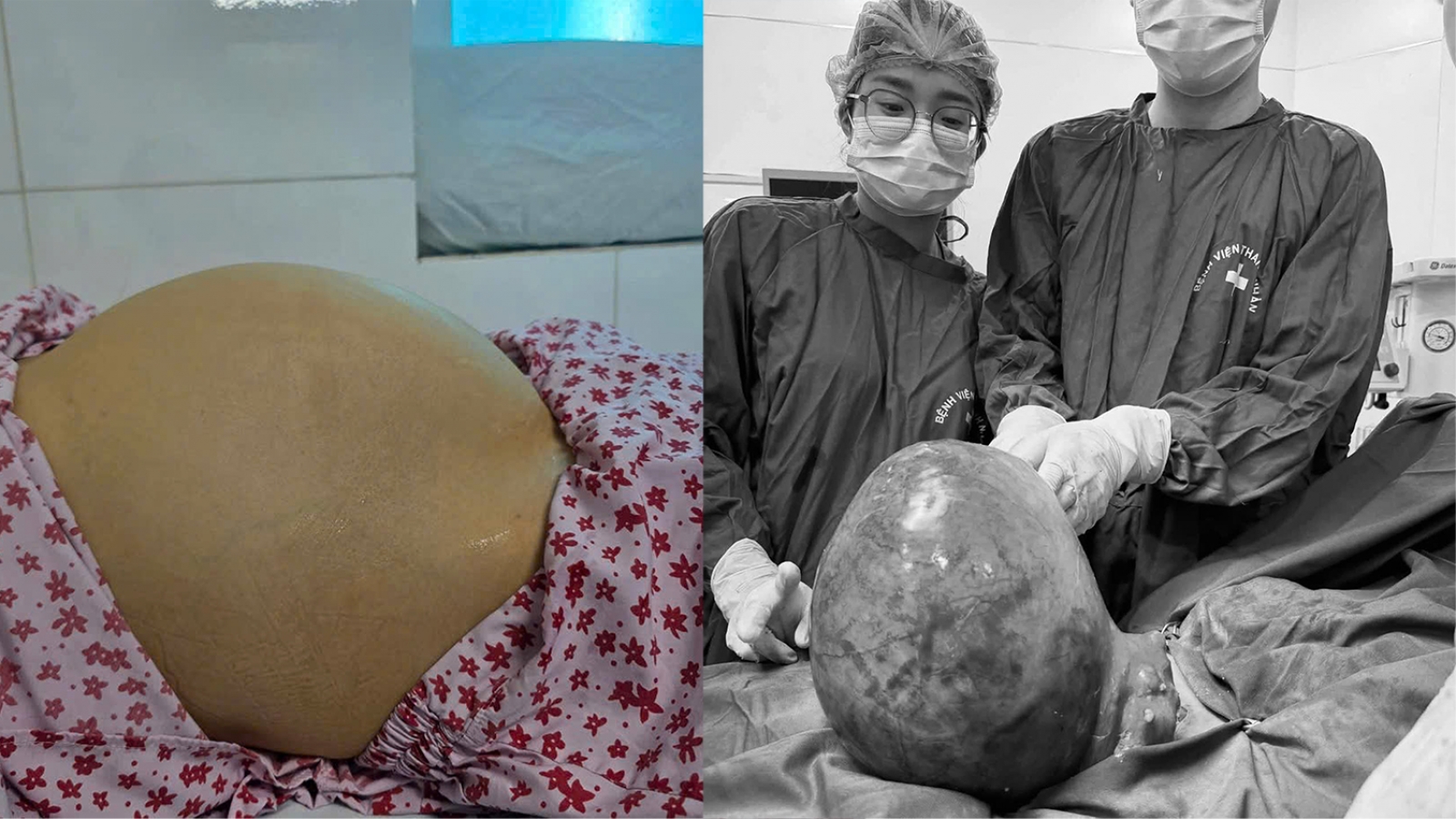 Bụng to bất thường, người phụ nữ Hà Nội bất ngờ với khối u xơ tử cung 6kg
