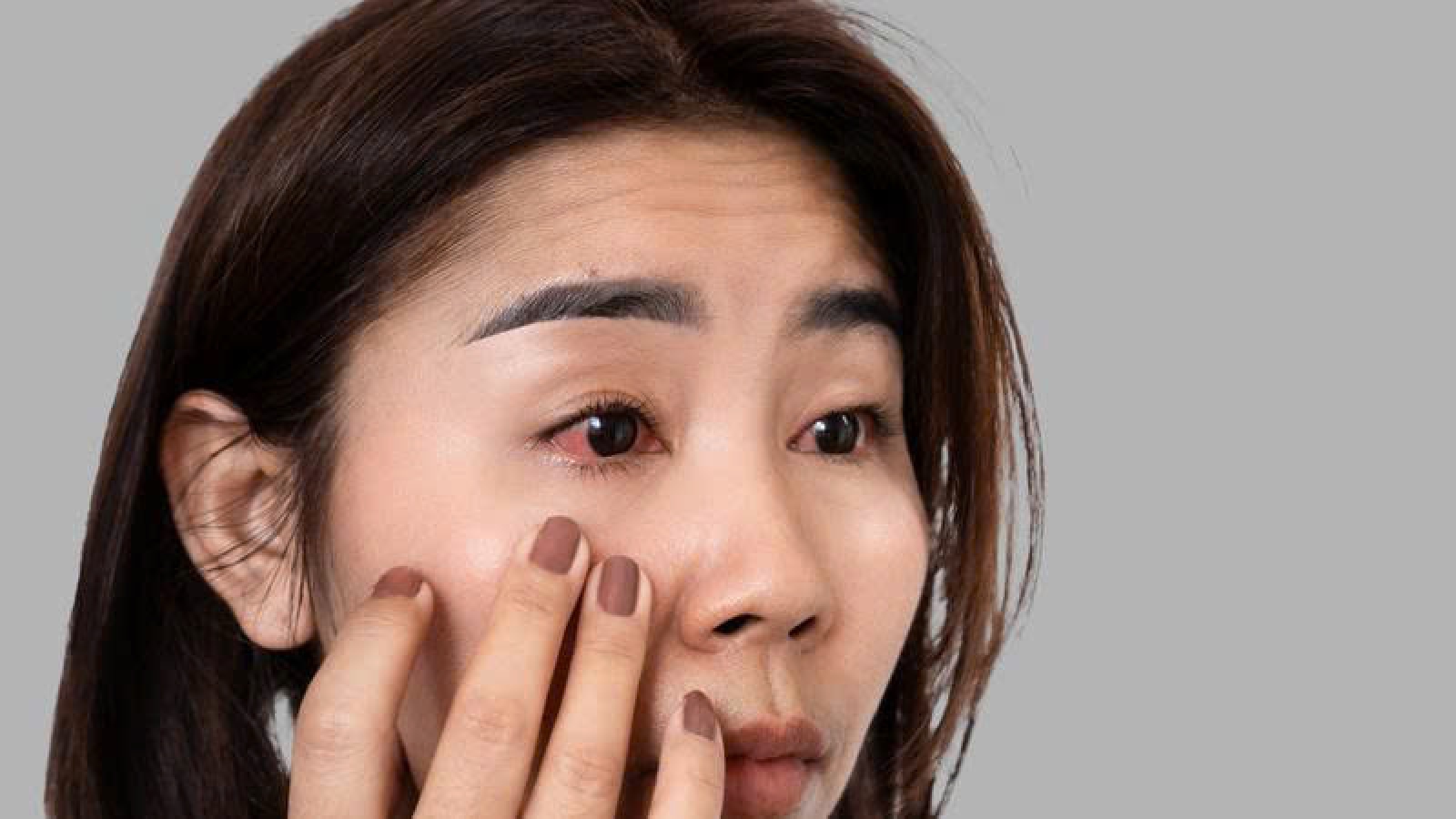 Nhện đái vào mắt có gây mù? Cách xử lý đúng