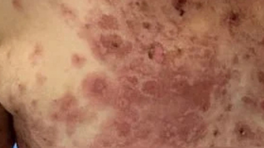 Nhiều bệnh nhân dị ứng nặng sau điều trị bằng thuốc nam