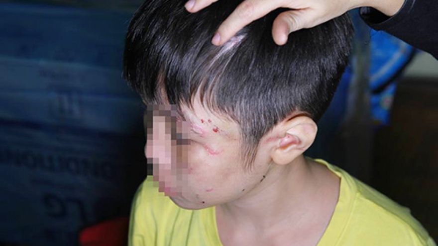 Hanoi man arrested for battering starving 10-year-old son