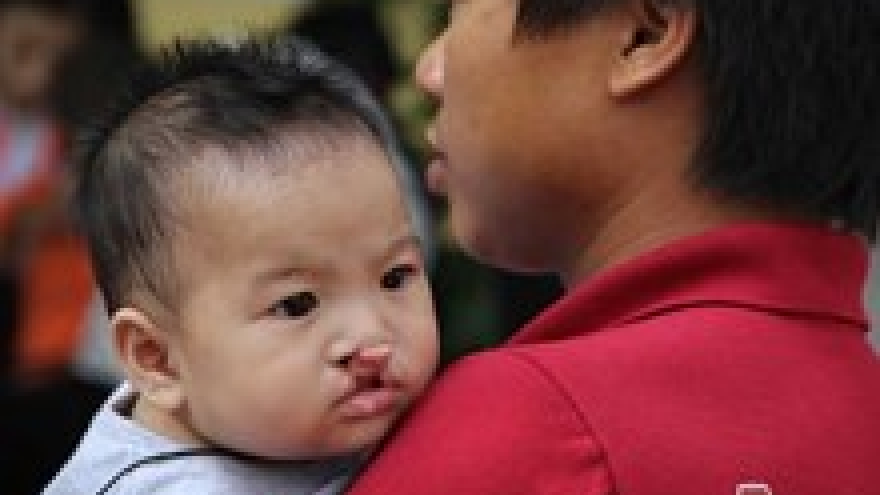 Vice President presents gifts to child patients with facial defects