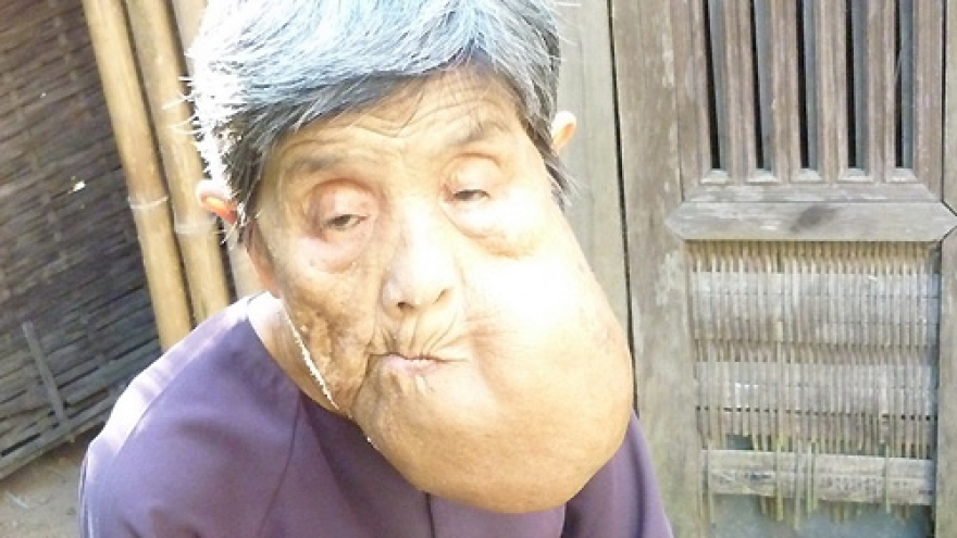 Old woman carrying huge face tumor