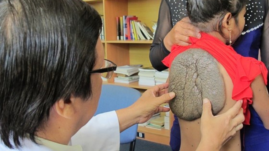 Vietnamese doctors successfully remove ‘turtle shell’ on 10-year-old girl’s back