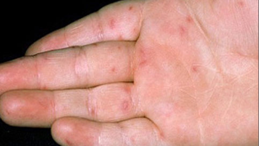 Hand, foot and mouth disease strikes Hanoi