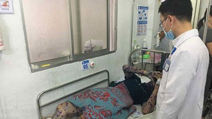 City export zone reports outbreak of chickenpox