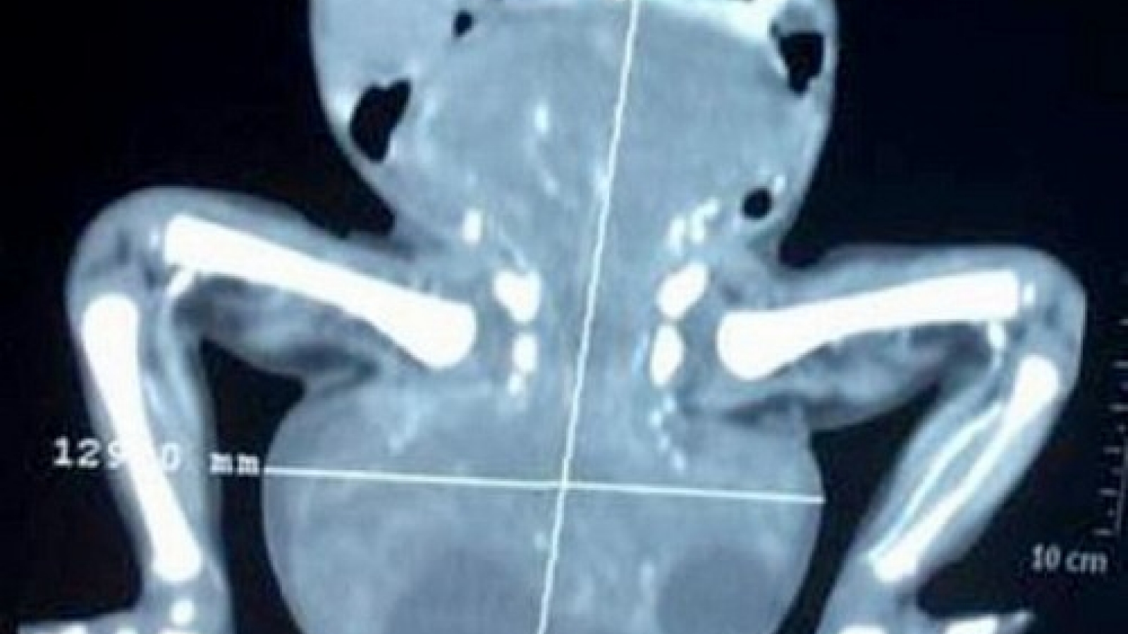 Vietnamese doctors remove giant tumor from newborn infant