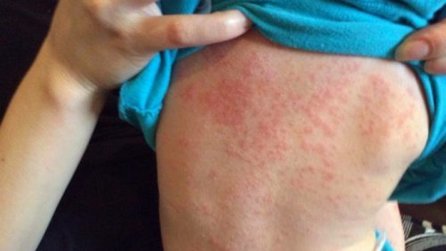 89 cases of measles recorded in Hanoi 