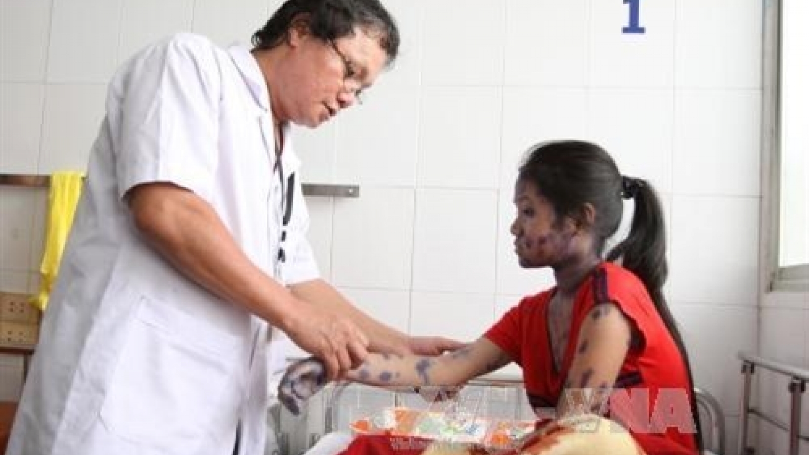 HCM City warns against chicken-pox outbreaks