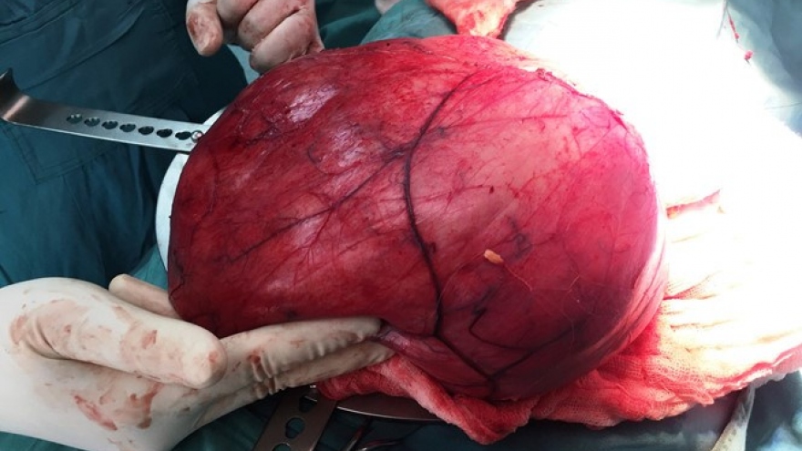 Vietnamese woman mistakes large tumor for pregnancy