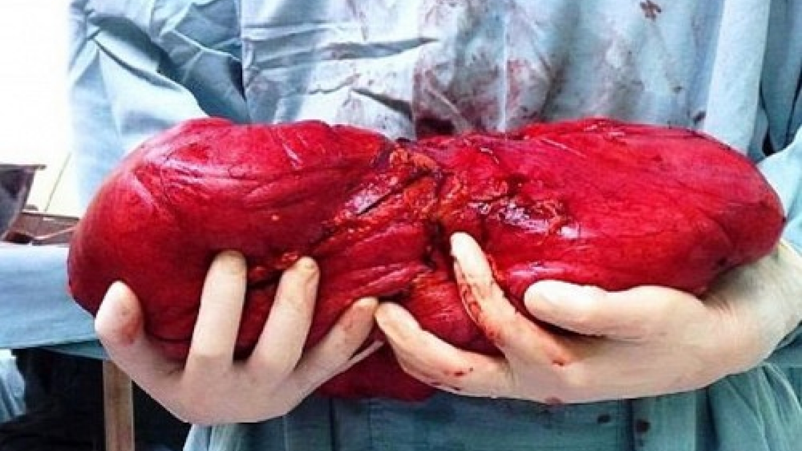 Doctors remove 6kg fatty tumor from quinquagenarian woman