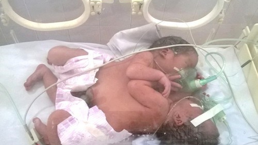 Vietnam conjoined twins die week after birth