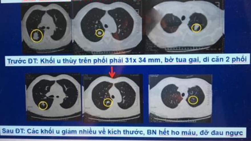 Vietnam has high hopes for new cancer therapy