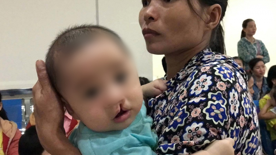 Free surgeries for children with cleft lip and cleft palate