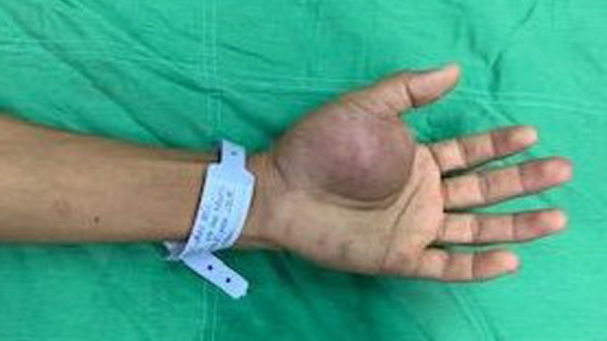 Phẫu thuật thành công cho bệnh nhân bị bướu máu vùng bàn tay