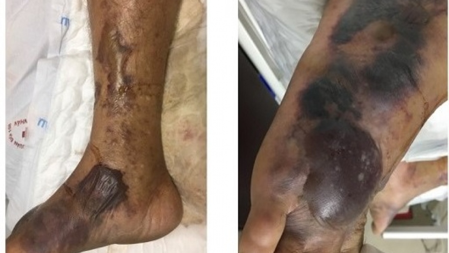 Cảnh giác với loài “vi khuẩn ăn thịt người” đến từ biển