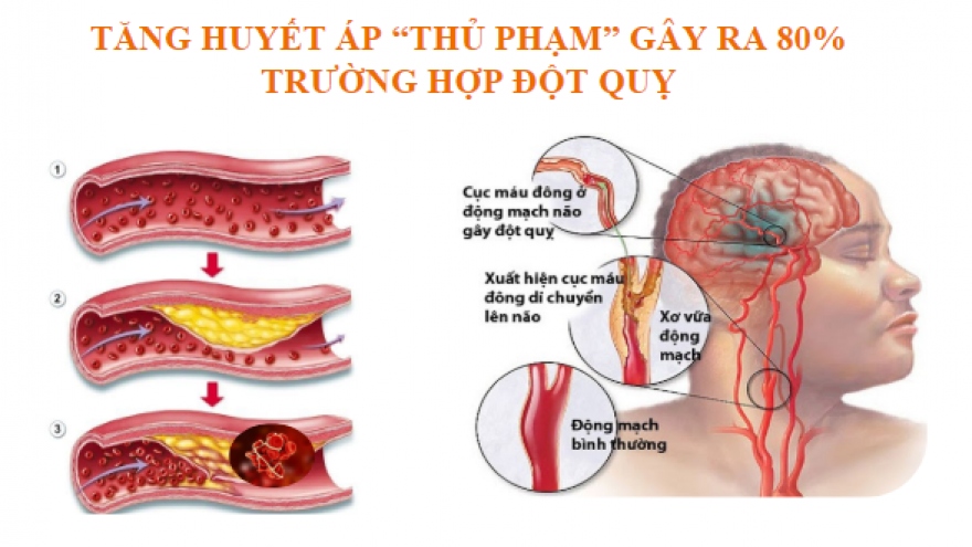 Trên 80% người bị tăng huyết áp ở Việt Nam chưa được điều trị