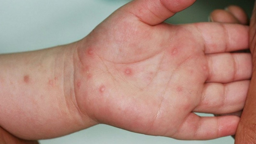 Dự báo số ca mắc tay chân miệng sẽ gia tăng thời gian tới