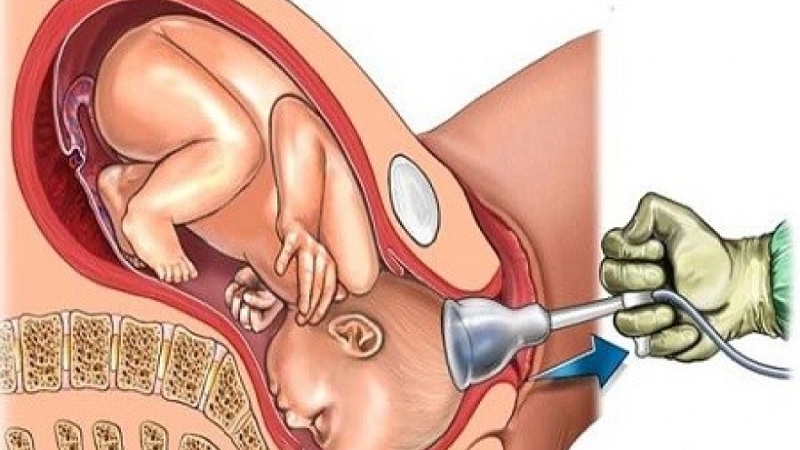 Nhức nhối nạn phá thai chui