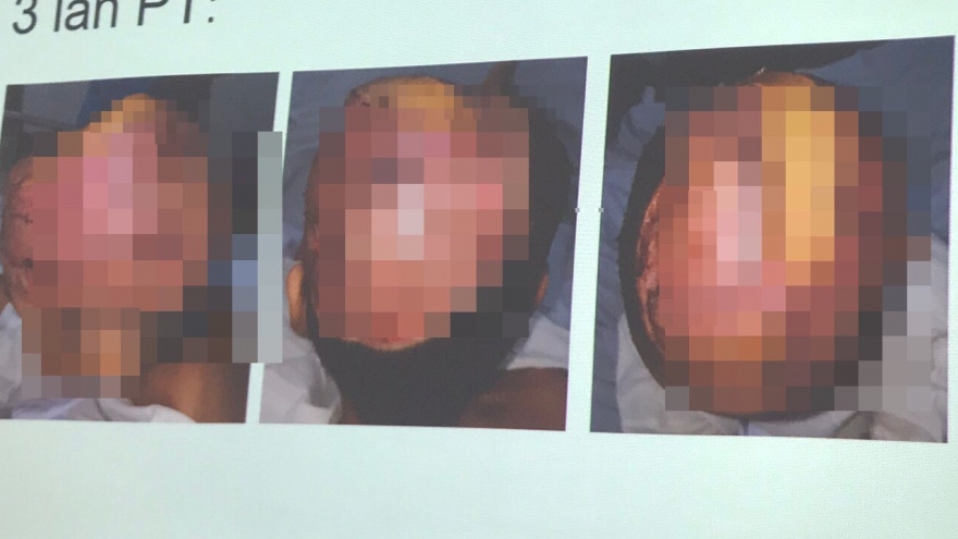 Bị cuốn tóc vào máy xay đá, một bé gái tróc hết da đầu