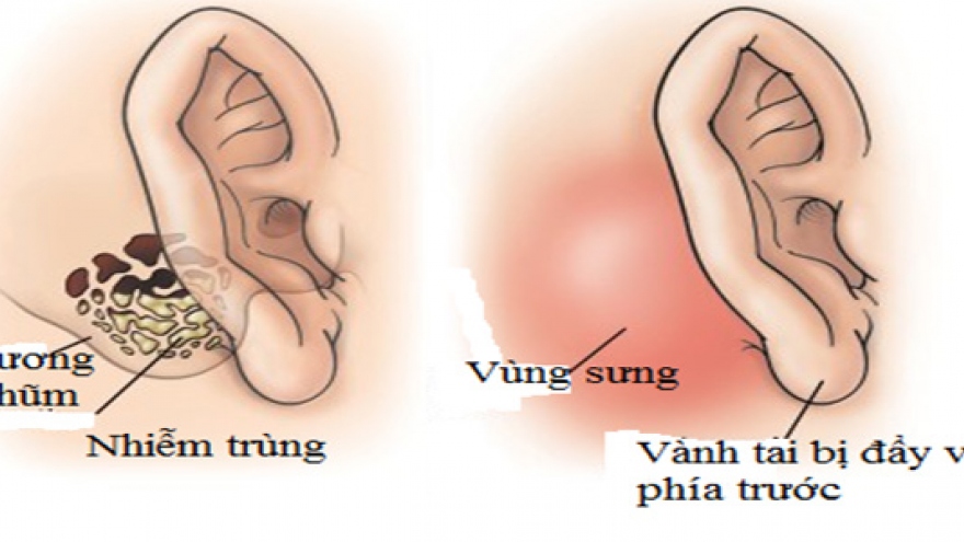 Tình trạng hôi tai có liên quan đến vấn đề vệ sinh cá nhân không?
