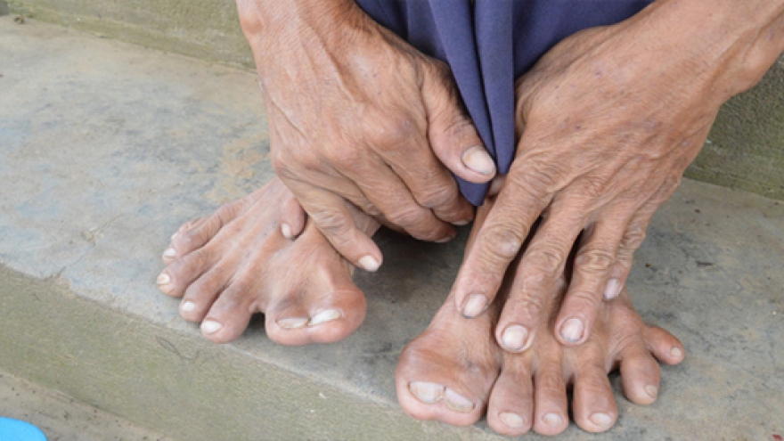 Tận thấy người đàn ông có 25 ngón tay, chân ở Đồng Tháp