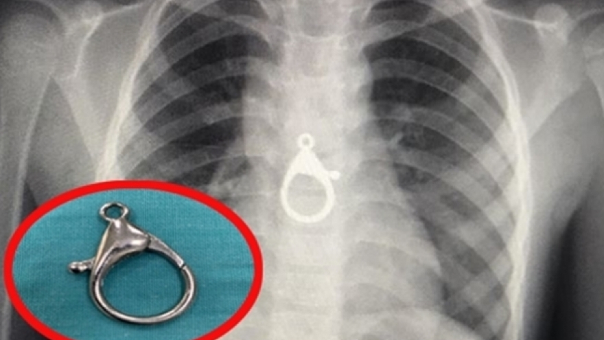 Nuốt phải móc khóa, bé trai 5 tuổi nhập viện cấp cứu