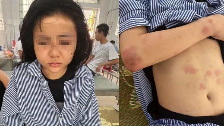 Cô gái bị kẻ yêu đơn phương đánh dã man tại nhà riêng