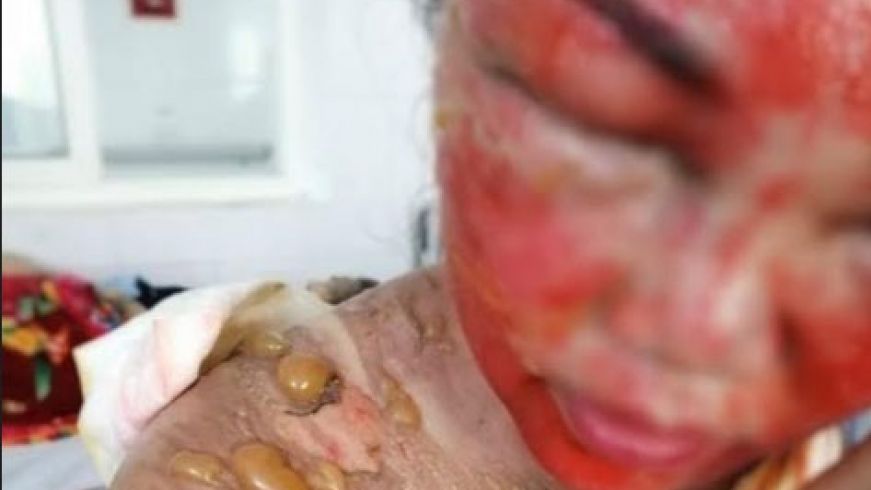 Chồng đổ cả ấm nước sôi lên đầu khiến vợ bị bỏng nặng