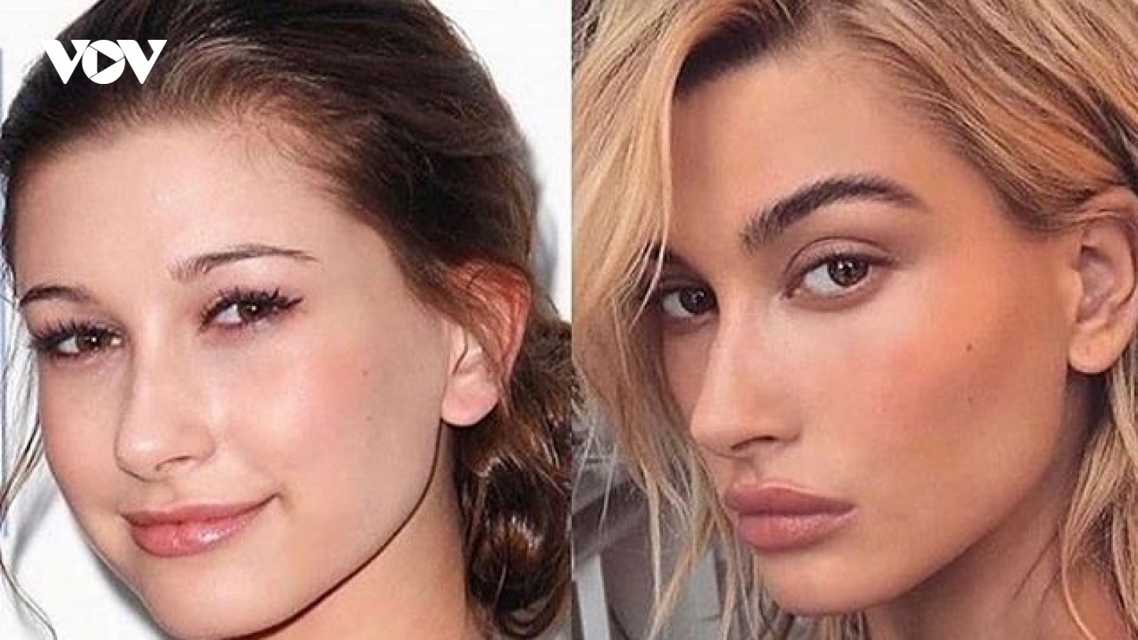 Vợ Justin Bieber tức giận đáp trả khi bị nghi phẫu thuật thẩm mỹ
