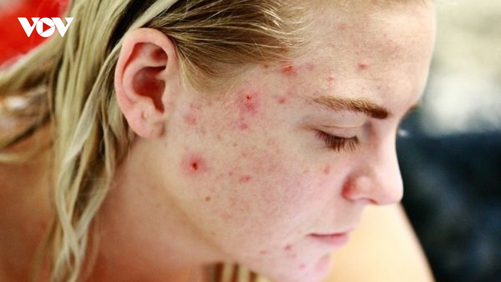 Cách đối phó với tình trạng da kích ứng, nổi mụn