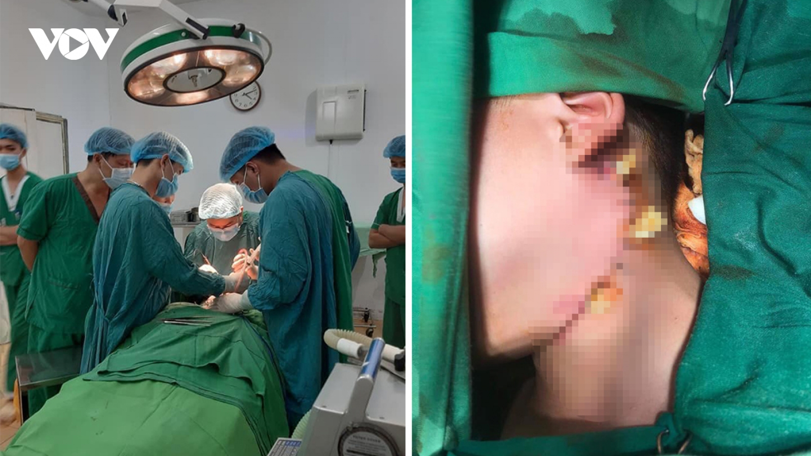 Cứu sống bé trai bị cành cây đâm vào vùng cổ