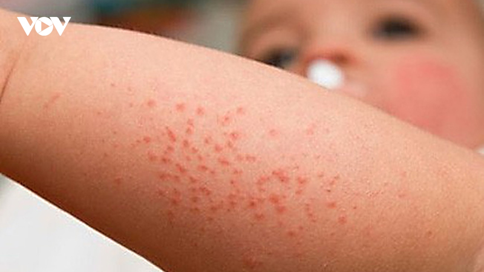Nhiều ổ dịch sốt xuất huyết mới tại Hải Dương