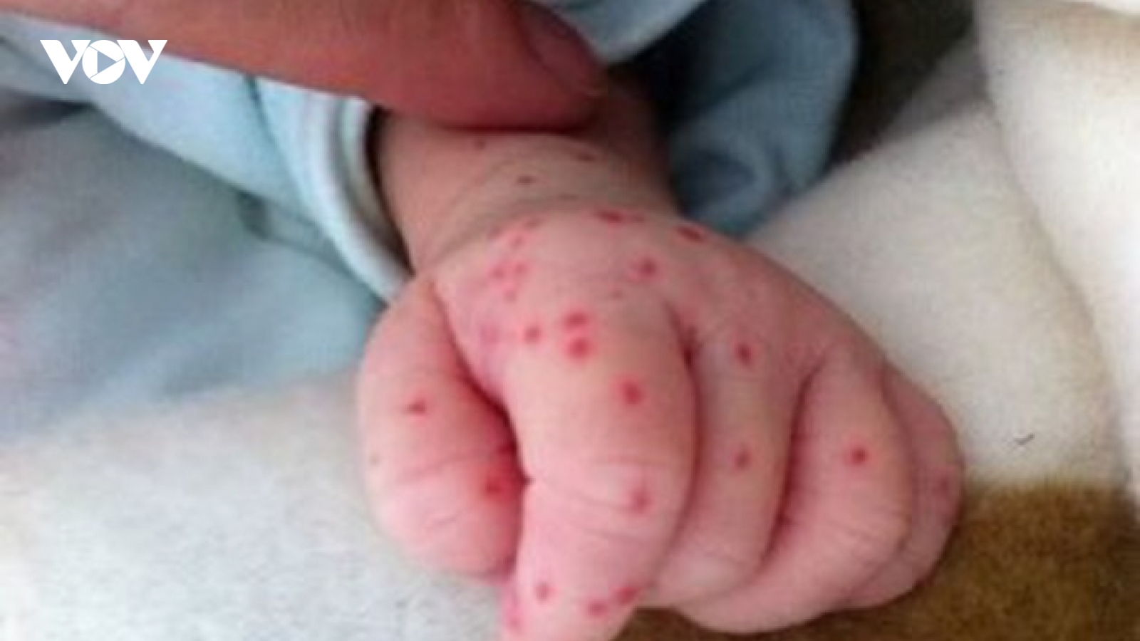 Đỉnh dịch sốt xuất huyết sẽ vào tháng 10-11 tới